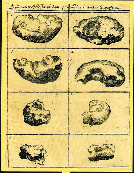 piedras en la próstata y vejiga ciudad de illinois piedras en la próstata y vejiga ciudad de illinois